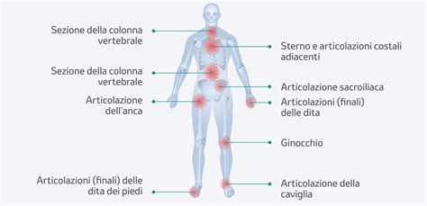 Artrite psoriasica al piede
