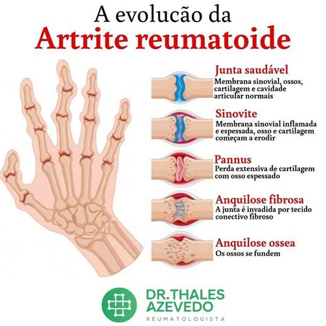 Artrite reumatoide