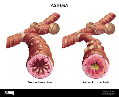 Asma bronchiale