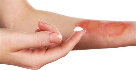 Bruciatura da freddo