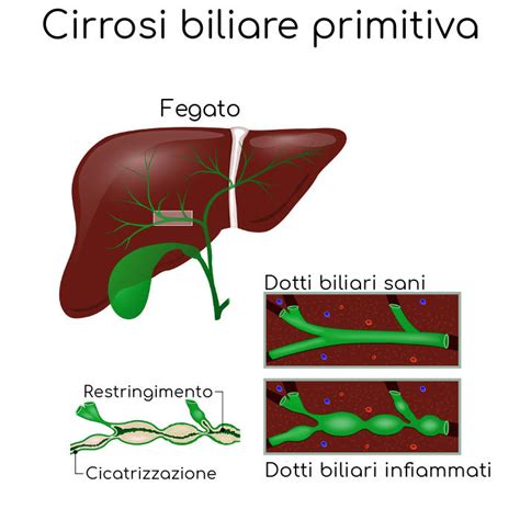 Cirrosi biliare primitiva