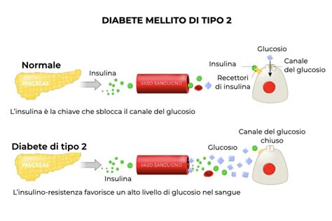Diabete Mellito Tipo 2