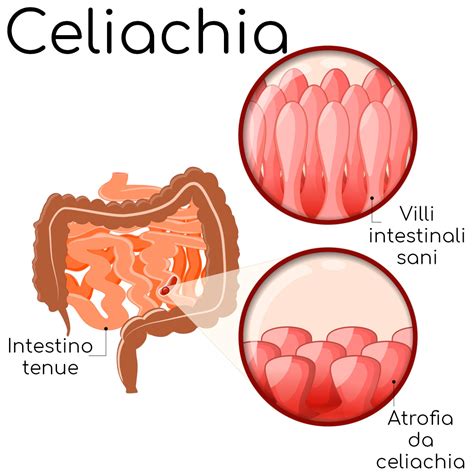 Diagnosi della celiachia