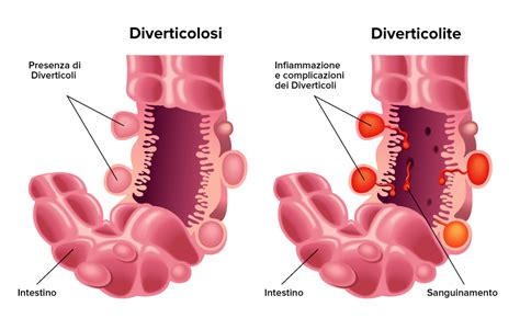 Diverticolite e Insalata
