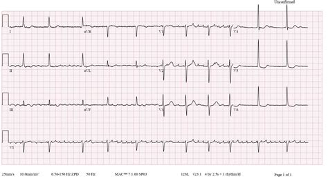ECG
