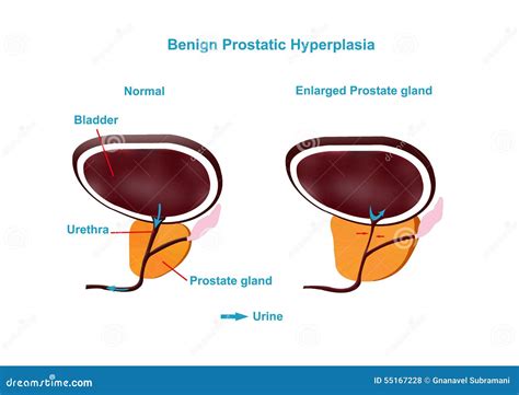Iperplasia Prostatica Benigna