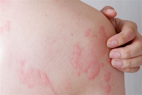 Orticaria