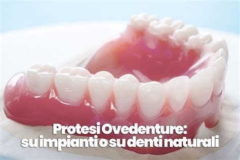 Quando serve un adesivo per dentiera