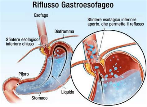 Reflusso Gastroesofageo