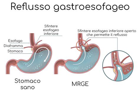 Reflusso Gastroesofageo nei Neonati