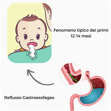 Reflusso nei neonati