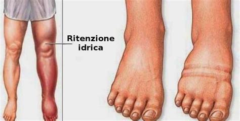 Ritenzione idrica