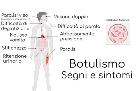 Sintomi botulino